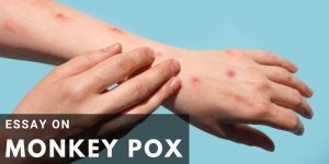 Read more about the article Essay on Monkey pox